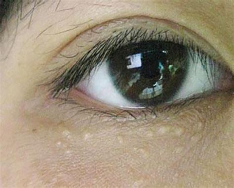 【图】眼睛上长脂肪粒怎么办呢 8大妙招解决你的问题_眼睛上长脂肪粒怎么办_伊秀美容网|yxlady.com