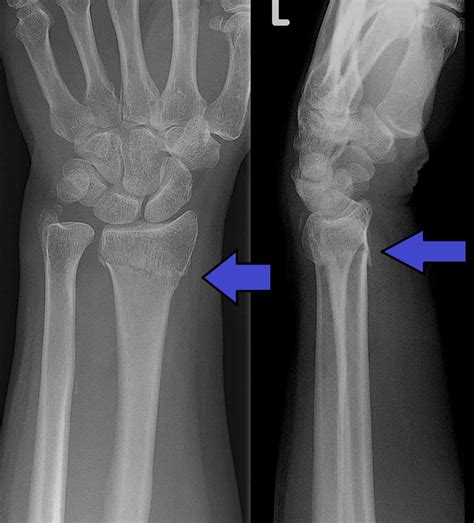 Distal Radial Fractures - Scrub Book