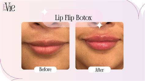 How Botox Lip Flip Refines Your Smile With La Vie Clinic Experts | Rochester Hills, MI