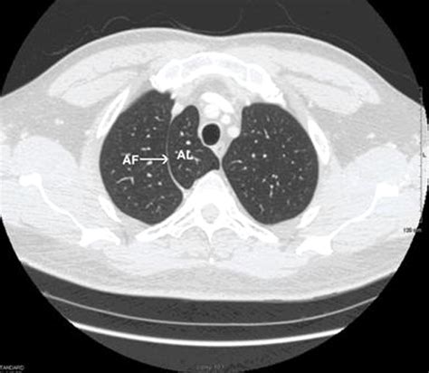 The azygos lobe and vein: interesting and typical clinical image | BMJ Case Reports