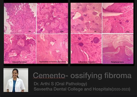 Cemento-ossifying fibroma — ORAL PATHOLOGY-SAVEETHA
