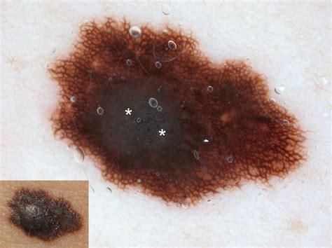 Is Your Mole Cancerous? Detecting Skin Cancer with Dermoscopy