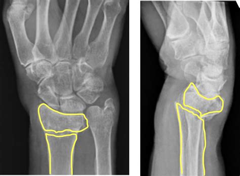 Radius Fracture 的图像结果