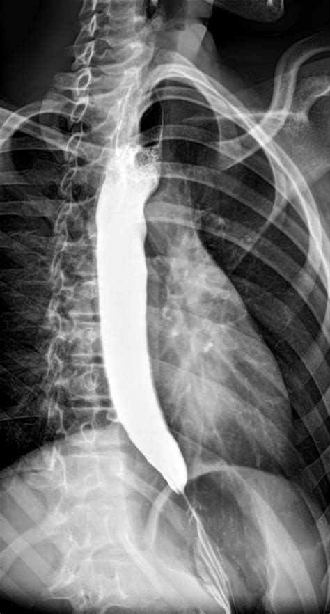 Esophageal Achalasia Wikipedia