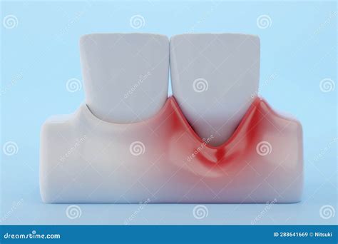 Recession Teeth 的图像结果