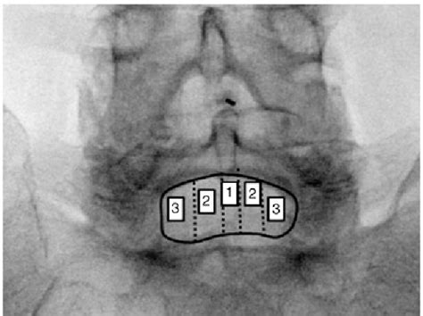 Image result for Contralateral Oblique View
