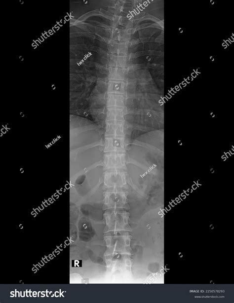 Ap Lumbar Spine Xray