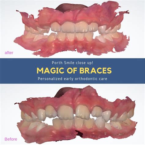 How To Eat With Bite Blocks On Molars at Donald Bryan blog