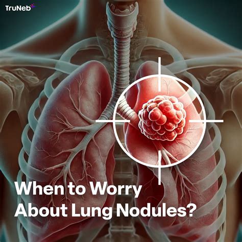 When to Worry About Lung Nodules: A Comprehensive Guide