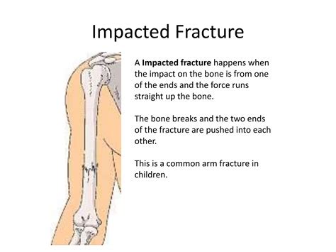 Fractured bones | PPTX