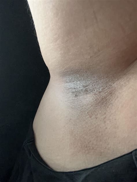 Armpit bump for months, thinking it’s a lymph node? No positive test. : r/lymedisease