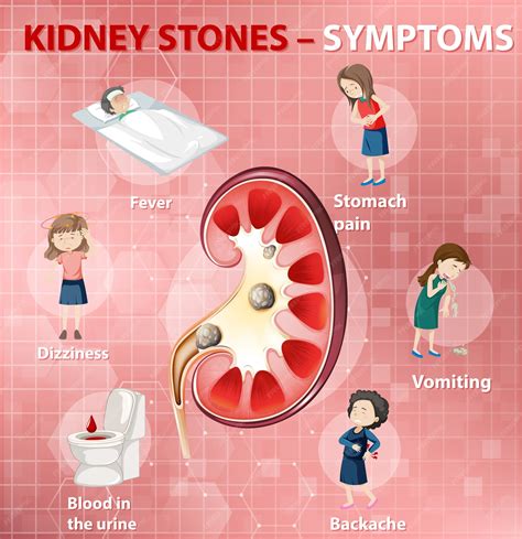 Kidney Stone Pain Chart