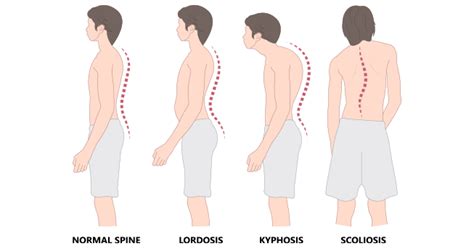 What Is Kyphosis? Meaning, Causes & Back Hunch Explained