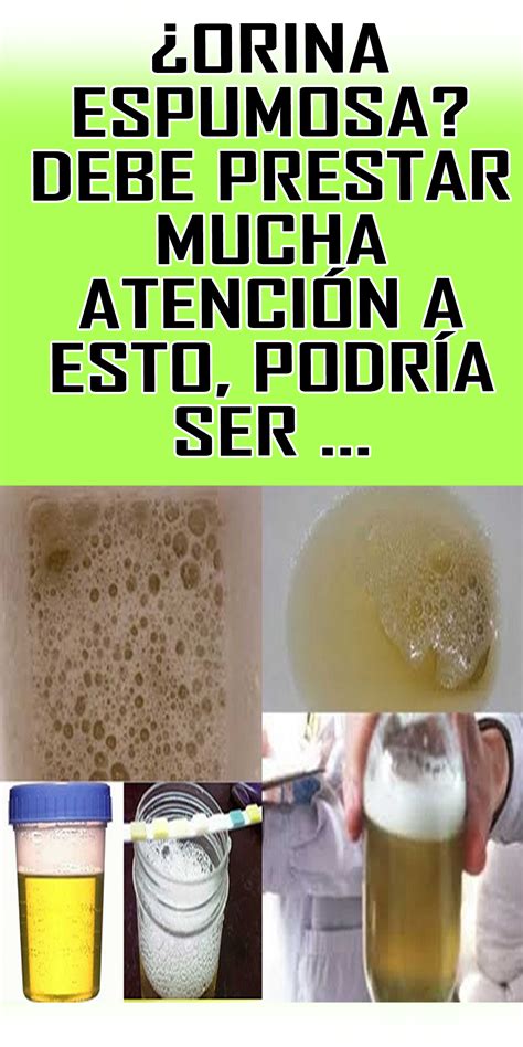 Que Significa Tener Proteina En La Orina