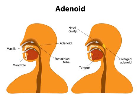 Can Adenoids Grow Back In Adults