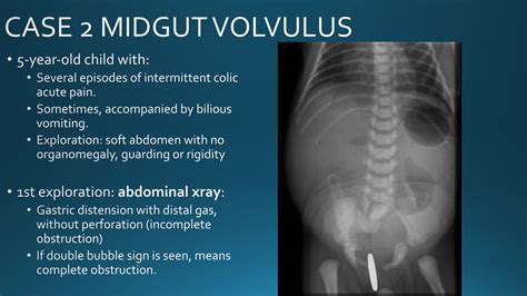 Midgut Volvulus X Ray
