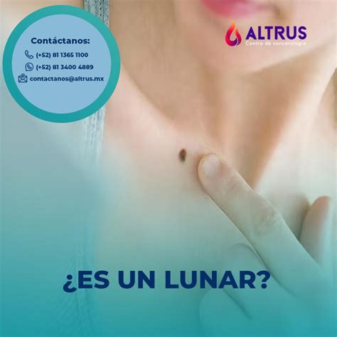 Piel - Nevo - ALTRUS cancerología