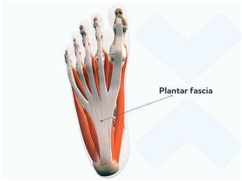 Surgery for plantar fasciitis: What you need to know