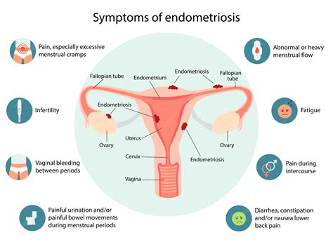 Infografía de los síntomas de la endometriosis infografía vectorial ...