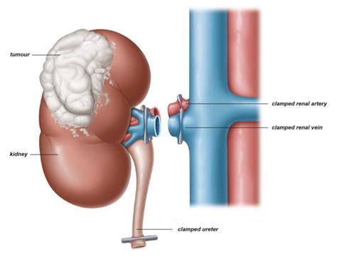 Image result for Hand-Assisted Radical Nephrectomy