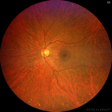 Bull’s eye maculopathy related to antimalarial drugs – Retinography