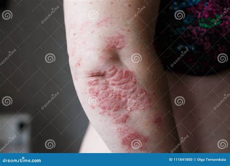 Psoriasis Skin. Psoriasis is an Autoimmune Disease that Affects the Skin Cause Skin Inflammation ...