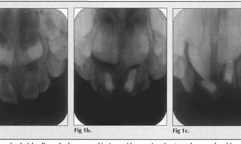 Pulpectomy treatment of choice for necrotic primary molars compared to ...