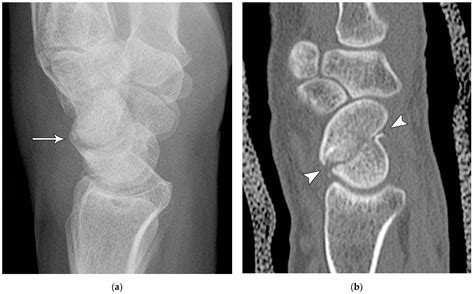 Imaging Diagnosis and Management of Carpal Trauma and Instability—An ...