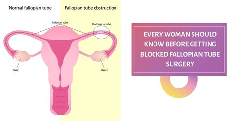 Image result for Fallopian Tube Surgery