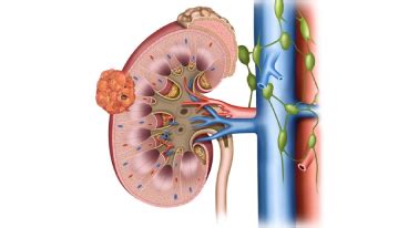 Image result for Steps of Partial Nephrectomy