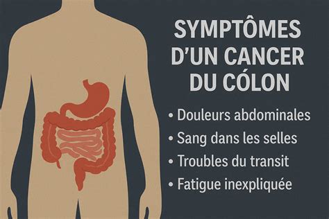 Les 7 symptômes principaux d'un cancer du côlon à repérer