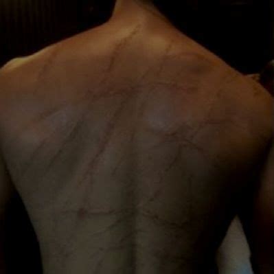 19 people who survived getting struck by lightning show what it does to ...