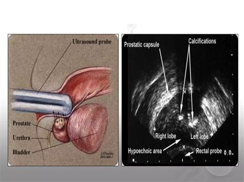 Prostate Radiation Simulation 的图像结果