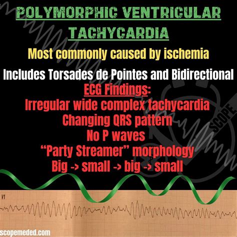 Polymorphic Ventricular Tachycardia Ecg Polymorphic Ventricular
