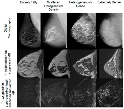 Diabetes, Obesity, and Inflammation: Impact on Clinical and Radiographic Features of Breast Cancer
