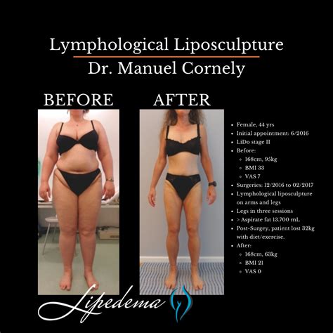 I Cured My Lipedema