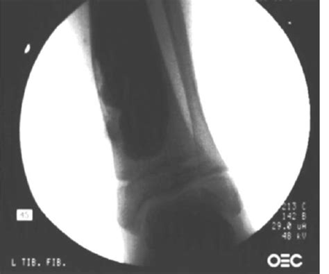 Image result for Fluoroscopy Injection