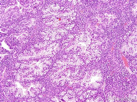 Spindle Cell Carcinoma Uterus at Larry Artiaga blog