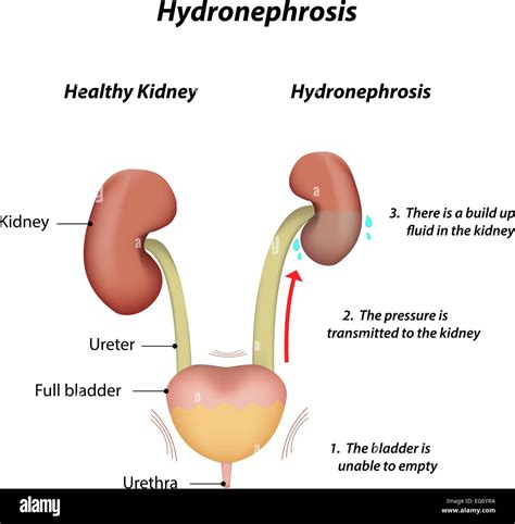 Hydronephrosis Of The Kidney High Resolution Stock Photography and ...