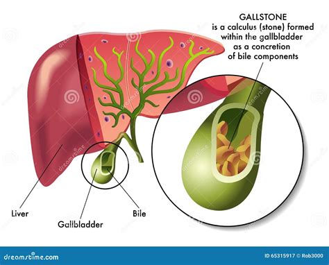 Gallstones. Cholelithiasis. Cholecystitis. Inflammation Of The ...
