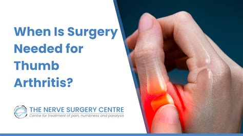 When Is Surgery Needed for Thumb Arthritis? - The Nerve Surgery Centre