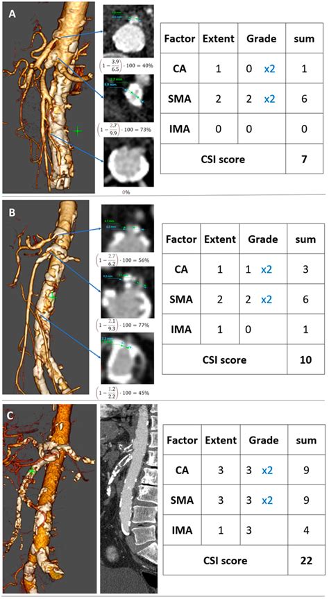 Development of a Novel Scoring Model to Estimate the Severity Grade of Mesenteric Artery Stenosis