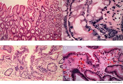 Efficacy of narrow-band imaging for detecting intestinal metaplasia in adult patients with ...