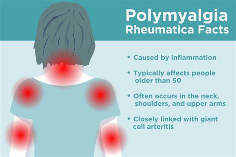What Cures Polymyalgia Rheumatica