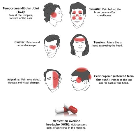 Conquering Headaches: How Physiotherapy Offers Effective Relief and Long-Term Solutions