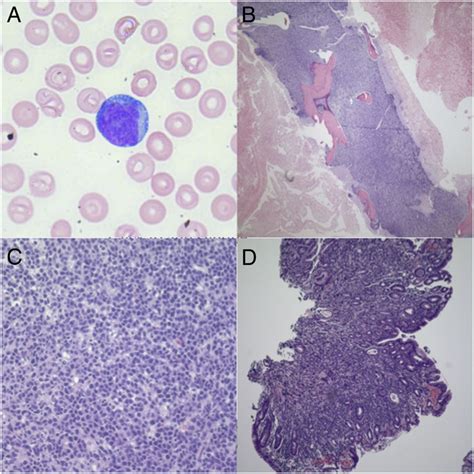 Circulating lymphoma cells of double-hit lymphoma | BMJ Case Reports