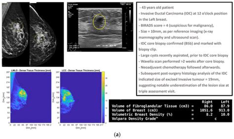 Wavelia Microwave Breast Imaging Phase#2 Clinical Investigation ...
