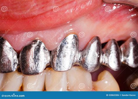 Metal Basis Dental Bridge stock photo. Image of denture - 32863306