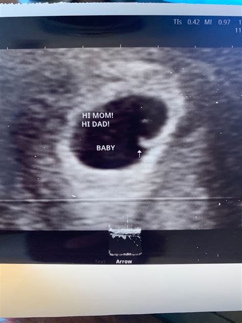 7 Week Ultrasound