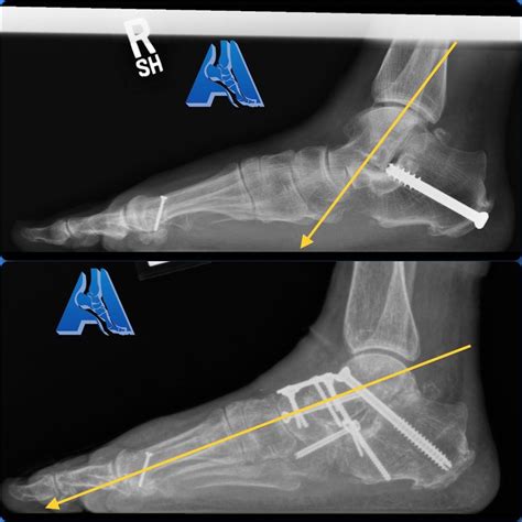 Failed Flat Foot Surgery Corrected with Revision Triple Arthrodesis ...